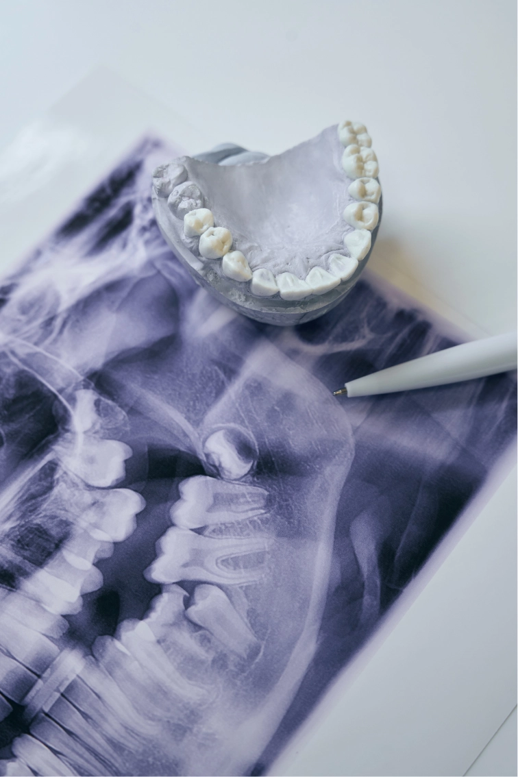 Dental X-ray and jaw model used to assess a wisdom tooth